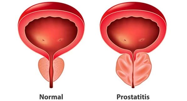 prostata normala vs Prostatita 